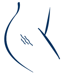 Cellulite Endematosa